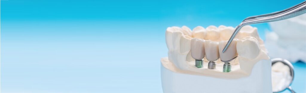 Discover the Power of Dental Implants: Your Path to a Confident Smile!